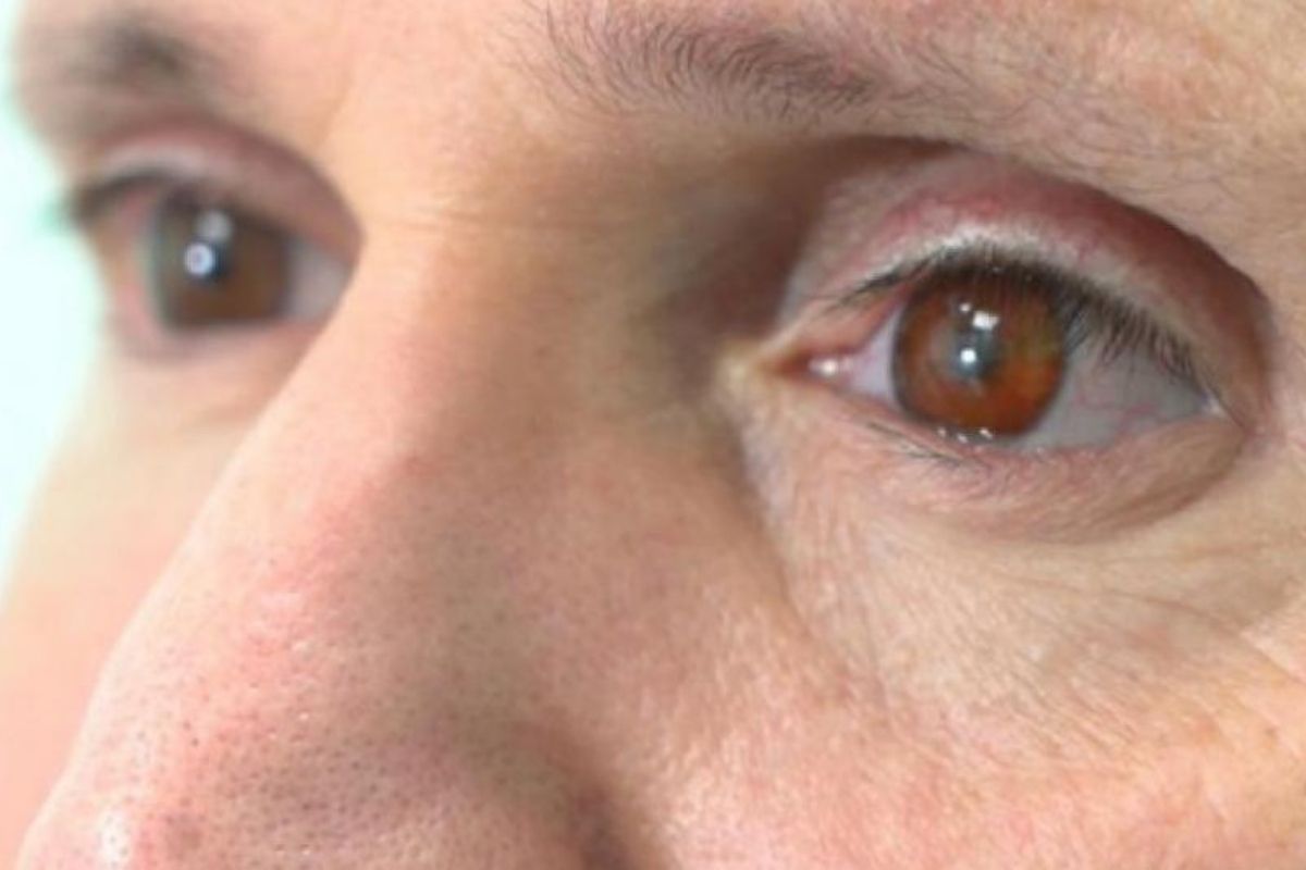 Occhio protesico stampato in 3D