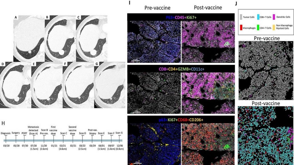 Regressione tumorale spontanea dopo il vaccino anti-Covid