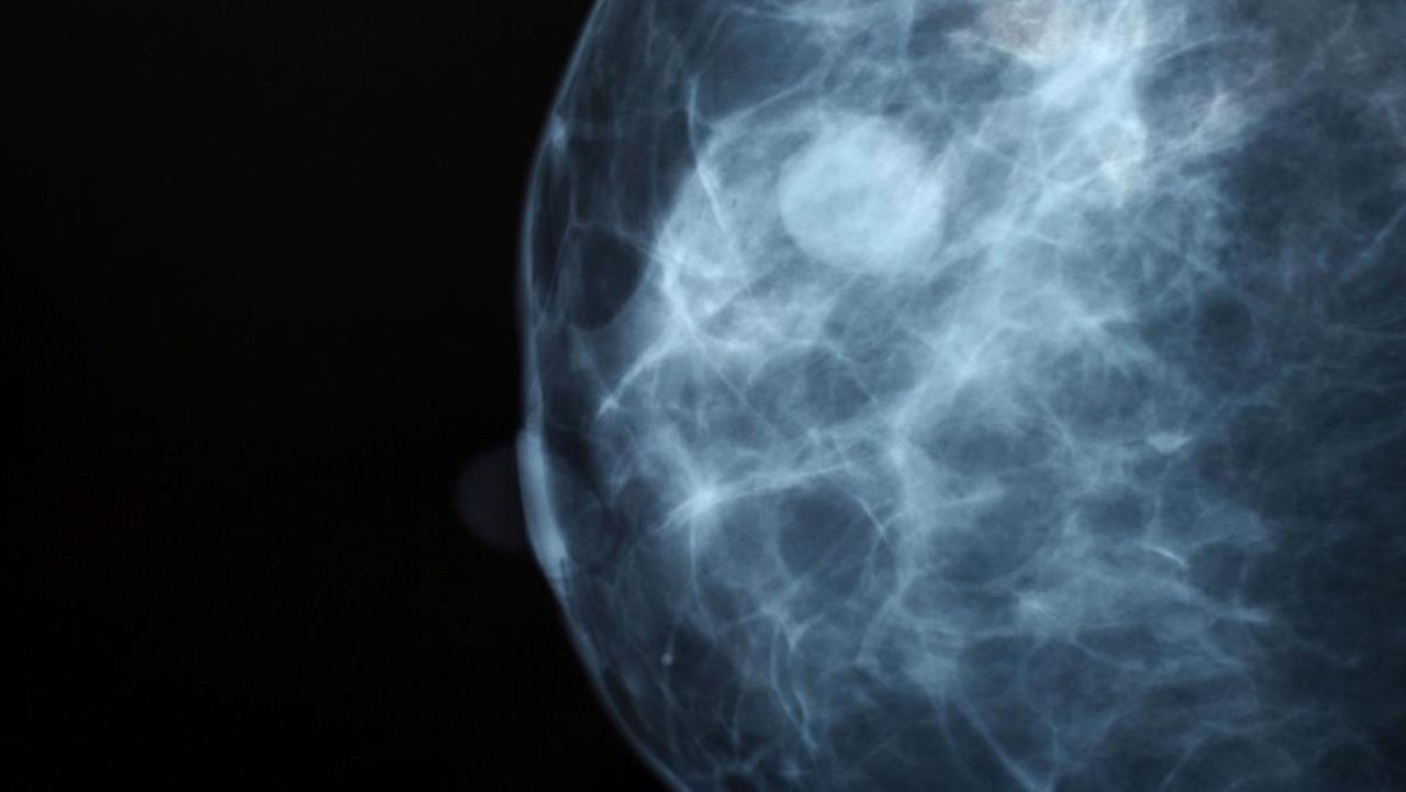 Carcinoma al seno