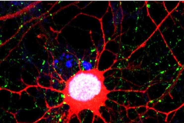 Cellula di glioblastoma che “imita” un neurone