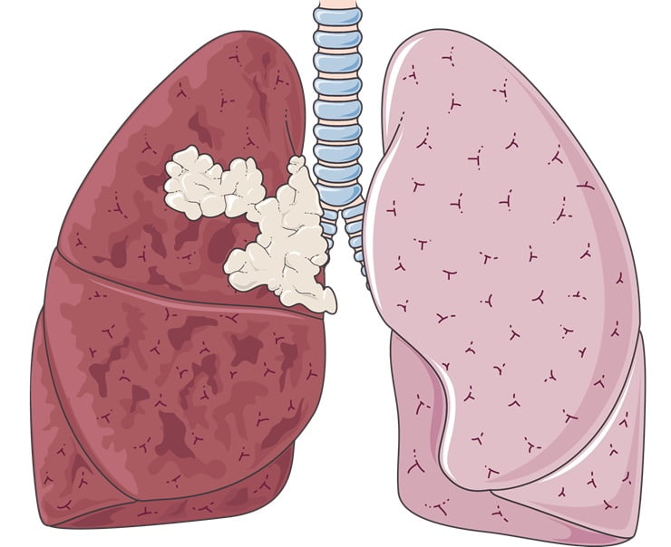 Tumore al polmone