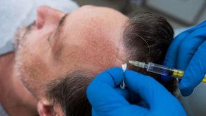 Trapianto capelli